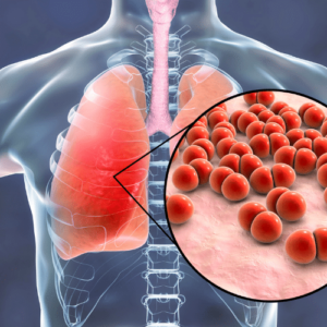 Nursing Care and Pathophysiology of Pneumonia