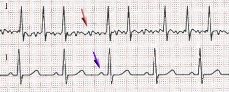 <span data-sheets-value="{"1":2,"2":"EKG of atrial fibrillation (top) and normal sinus rhythm (bottom). The purple arrow indicates a P wave, which is lost in atrial fibrillation."}" data-sheets-userformat="{"2":33555201,"3":{"1":0},"11":4,"12":0,"28":1}">EKG of atrial fibrillation (top) and normal sinus rhythm (bottom). The purple arrow indicates a P wave, which is lost in atrial fibrillation.</span>